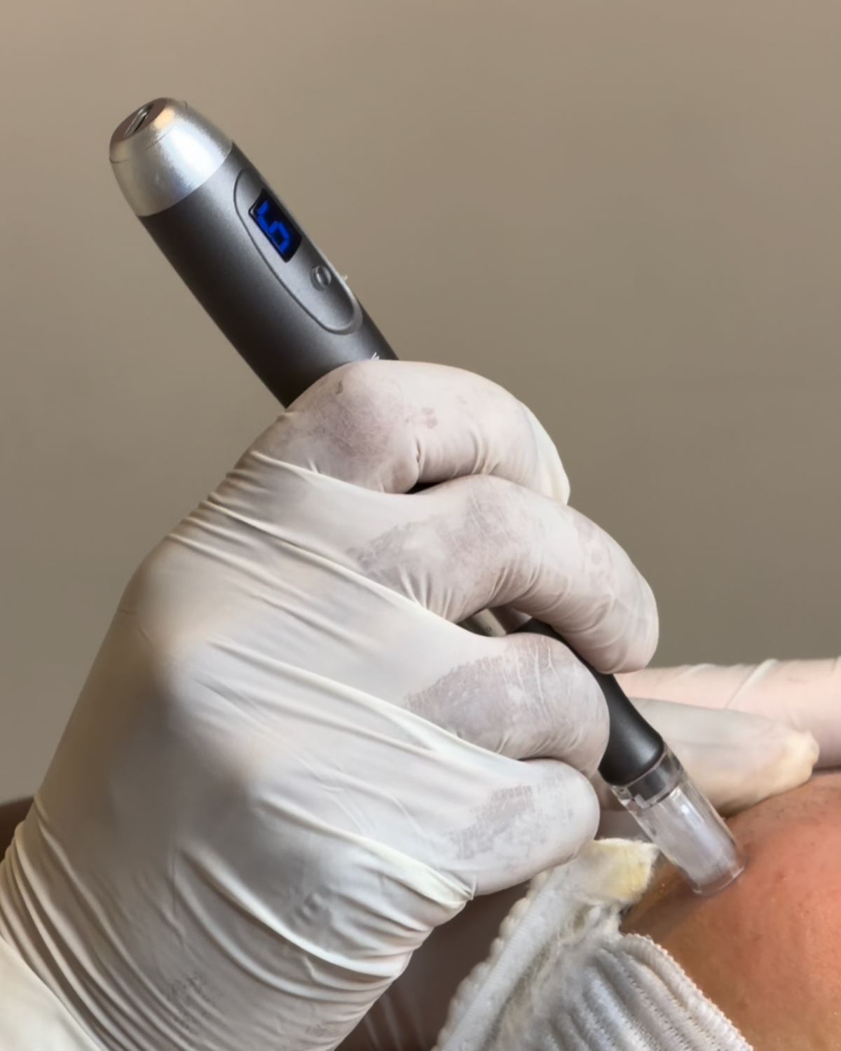Microneedling en Growth Factors voor intensieve huidverjonging van binnenuit.