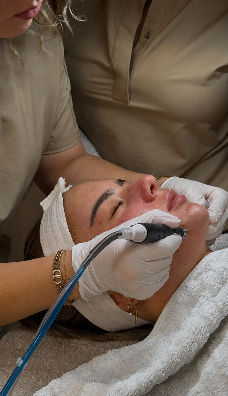 Acne Hydrafacial